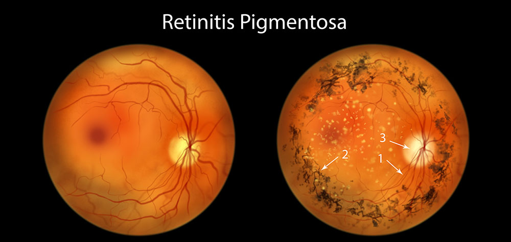 Retinitis%20pigmentosa